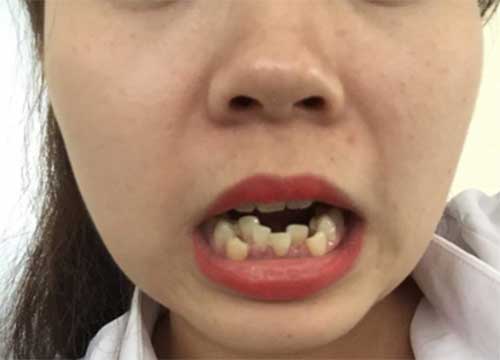 Bọc răng sứ cho răng khấp khểnh