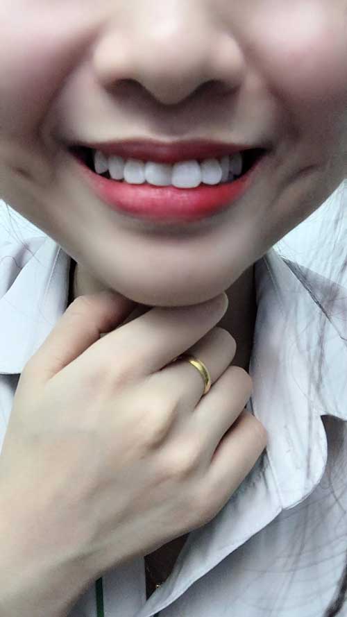 hàm răng sứ đẹp