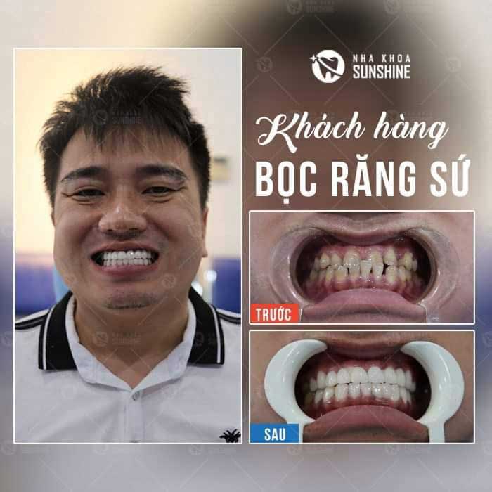 Bọc răng sứ 1 hàm bao nhiêu tiền