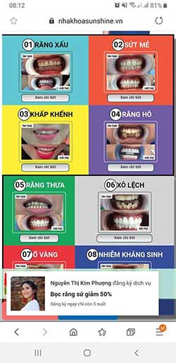 ưu điểm của bọc răng sứ thẩm mỹ
