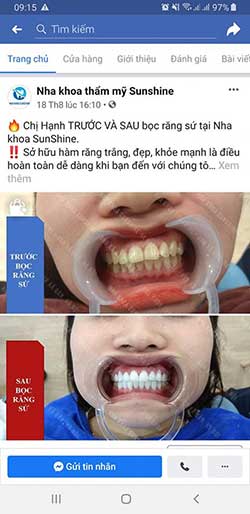 bọc răng sứ hỏng