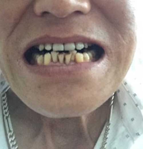 Bọc răng sứ tốt ở Hà Nội