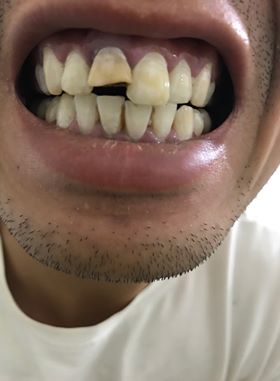 Răng bị sâu có bọc răng sứ được không