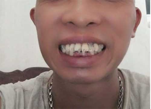Bọc răng sứ bao nhiêu tiền 1 răng