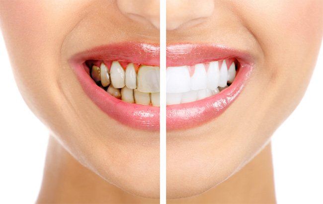 bản chất của phương pháp tẩy trắng răng là gì