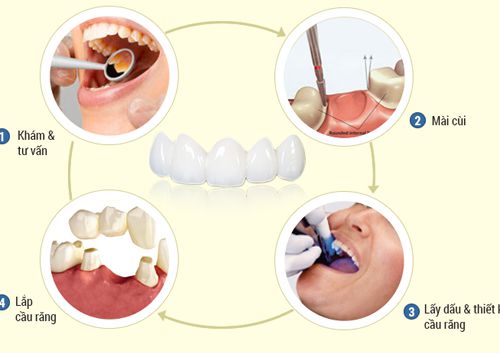 quy trình bọc răng sứ không gây đau nhức ê buốt