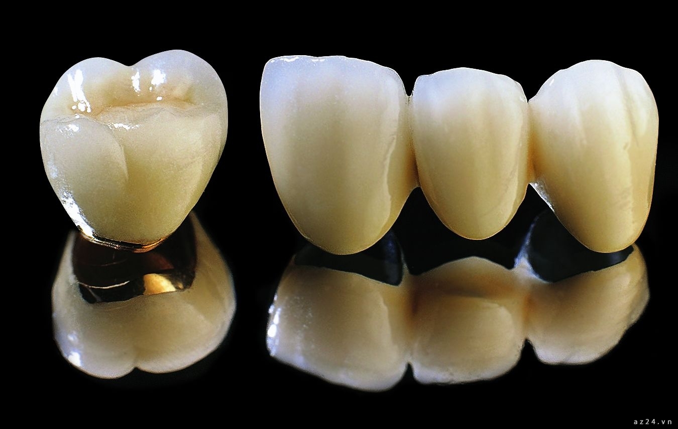răng sứ titan và răng sứ kim loại
