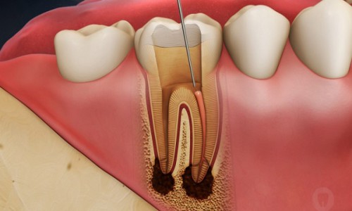 trường hợp nào cần lấy tủy trước khi bọc răng sứ
