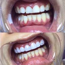 ưu điểm của phủ răng sứ
