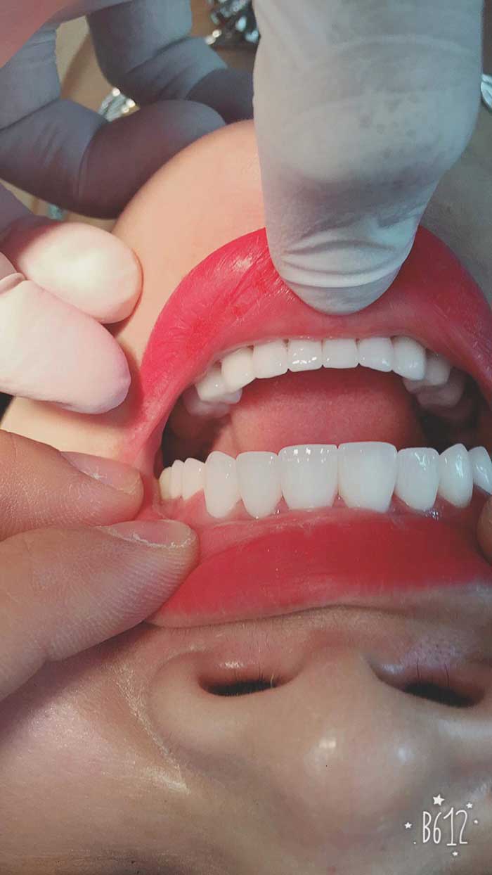 Bọc răng sứ không kim loại giá bao nhiêu