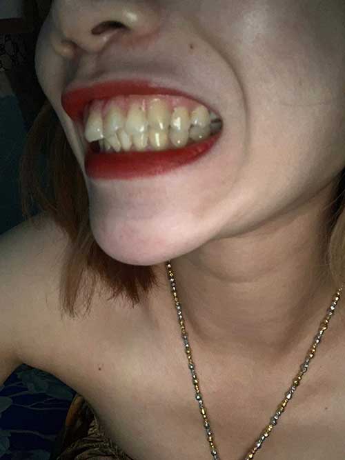 Các mẫu răng sứ đẹp