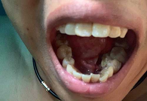 Bọc răng sứ có ảnh hưởng đến sức khoẻ không