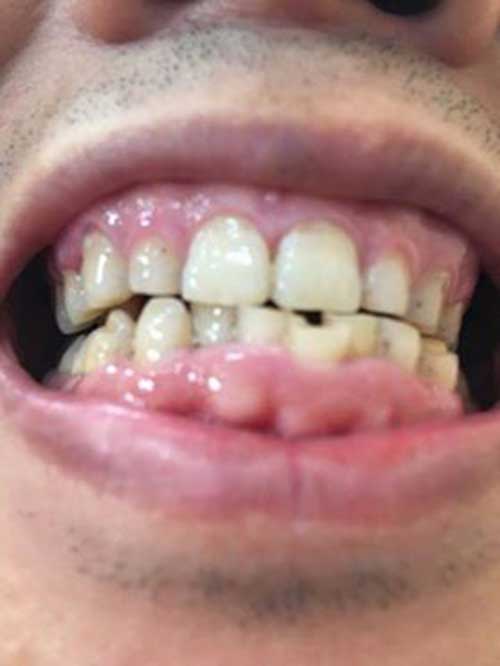 Bọc răng sứ cho răng hàm sâu