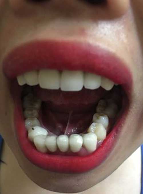 Tại sao bọc răng sứ lại bị hôi miệng