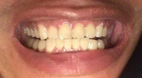 Lắp răng sứ bị tụt lợi