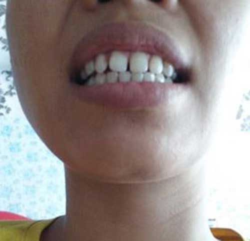 Những hàm răng sứ đẹp