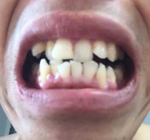 Lợi ích và tác hại của bọc răng sứ