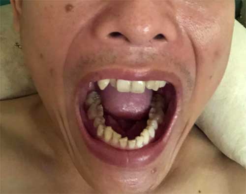 Giá bọc răng sứ bị sâu