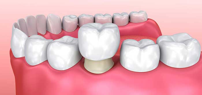 phương pháp bọc răng sứ là gì