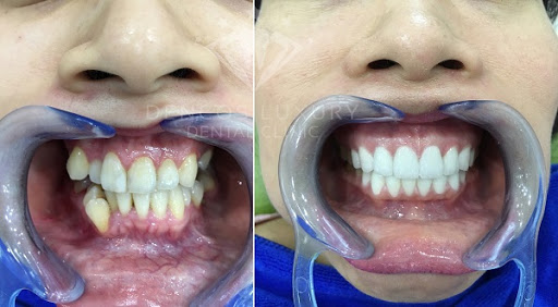 bọc răng sứ cho răng khấp kểnh được thực hiện như thế nào