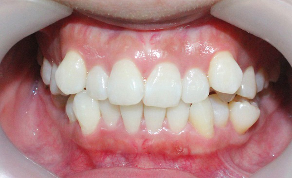 bọc răng sứ cho răng khấp khểnh