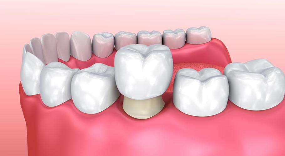 bọc răng sứ thẩm mỹ là gì