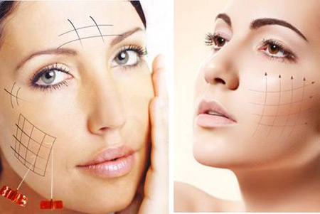 Căng da mặt bằng chỉ collagen là gì